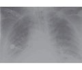 Особливості застосування концепції відкритих легень при респіраторній терапії тяжкої негоспітальної пневмонії