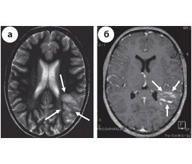 Atipical multiple sclerosis, Marburg variant: a case report and review