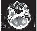 Albright Disease: A Clinical Case and Literature Analysis