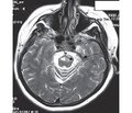 Cerebrovascular lesions in HIV-infection