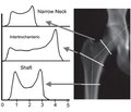 Reference indices of hip structural analysis in Ukrainian women