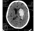 Prediction of the outcome of an acute period of recurrent cerebral ischemic hemispheric stroke