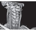 The role of stylo-carotid syndrome in the development of dissection of the internal carotid artery and cerebral infarction (a literature review and own observation)