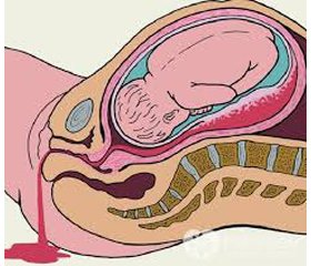 Роль и место экзогенных факторов свертывания крови при акушерских кровотечениях
