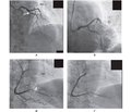 Fundamentals of diagnosis and treatment of pulmonary hypertension associated with left heart disease:  a clinical case