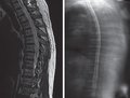 Paraneoplastic spinal cord syndromes (literature review and personal observation)