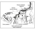 Postdural Puncture Headache: Etiology, Pathogenesis, Manifestations