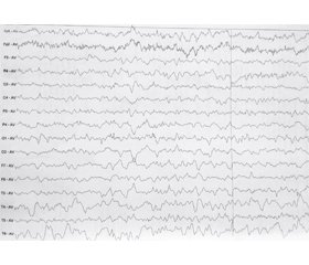 Hashimoto’s encephalopathy presenting with seizures: a case report