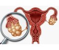 Взаємозв’язок синдрому полікістозних яєчників із певними чинниками та несприятливим перебігом вагітності