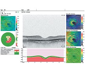 Ефективність сучасних методів вітреоретинальної хірургії наскрізних макулярних розривів на обох оча
