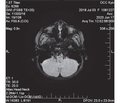 A clinical case of Louis-Bar syndrome with a clinical picture of cerebellar ataxia and EBV-associated lymphoproliferative syndrome