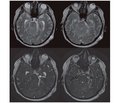 Trigeminal schwannoma: features of diagnosis and treatment (case report and review of literature)
