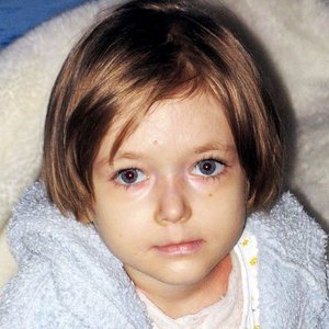 Буллезный эпидермолиз в Украине: украинским детям-бабочкам нужна помощь 