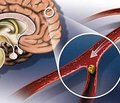 Нейропротекция при ишемическом инсульте: эффективность милдроната