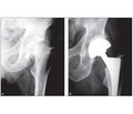 Хирургическое лечение медиальных переломов шейки бедренной кости