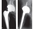 Методика установки ацетабулярного компонента эндопротеза тазобедренного сустава в условиях остеопороза при последствиях травм