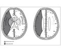 Comparative Characteristics of Radiological and Sonographic Criteria in the Dynamics of Hemispheric Ischemic Stroke under the Influence of Thrombolytic Therapy