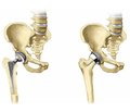 Femoral geometry and FRAX indices as independent risk factors for hip fractures in Ukrainian patients