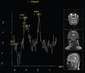Epilepsy and Migraine: Neuroimaging and Neuropathophysiological Parallels