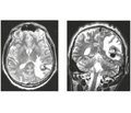Хірургічне лікування супратенторіальних каверном головного мозку, що проявляються судомним синдромом