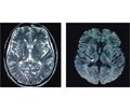 Clinical syndromes of thalamic strokes in posterolateral vascular territory: a prospective hospital-based cohort study