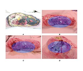 Прогнозування хронічного болю після тяжких ран за допомогою штучного інтелекту: пілотне відкрите дослідження