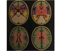 Chronic cerebral venous congestion in somatoneurology: diagnostic and treatment aspects