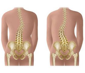 Association between bone turnover markers and leptin in girls with adolescent idiopathic scoliosis