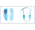 Роль остеосцинтиграфії та рентгенографії у хворих на остеонекроз при ендопротезуванні колінних суглобів
