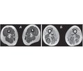 Opportunities of MRI in the early diagnosis of the progression of muscular dystrophies