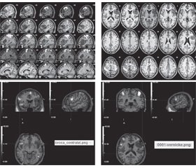 Role of extent of resection for the surgical outcome in low-grade oligoastrocytoma: a case study