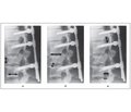 Рентгенопланіметрія при наслідках травм поперекового відділу хребта та спинного мозку в практиці медико-соціальної експертизи
