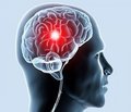 Early Rehabilitation after Acute Ischemic Cerebrovascular Events