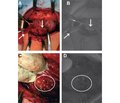 Improved intraoperative verification of parathyroid glands by determining their autofluorescence in the infrared spectrum