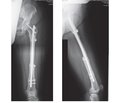 Step-cut osteotomy in case of alloplastic replacement of post-resection defects of long bones using a universal tool