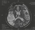 Crossed cerebellar diaschisis in acute stroke patients: case analysis and report