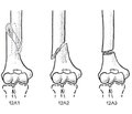 Surgical treatment of patients with extra-articular fractures of the distal humerus
