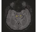 Association of susceptibility weighted imaging and mild parkinsonian signs in patients with small vessel disease