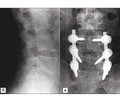 Reasons for repeated surgical interventions in patients after surgery for spinal disc herniation