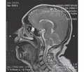 Autoimmune Hashimoto’s encephalopathy: a case report