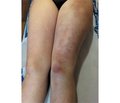 Clinical case of erythema ab igne caused by the laptop