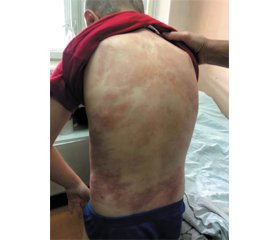 Toxicoderma in a child as a complication after a bedbug bite