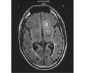 Symptomatic epilepsy in patients with multiple sclerosis (review of literature and analysis of own clinical cases)