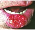 Клиника и дифференциальная диагностика рака слизистой оболочки полости рта и красной каймы губ