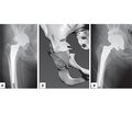 Наш досвід ревізійного ендопротезування кульшового суглоба