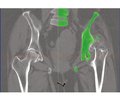 Використання 3D-моделювання з виготовленням пластикового прототипу в травматології та ортопедії (клінічні приклади)