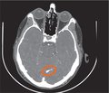 Venous occipital infarction in a young patient