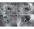 Ендоскопічна ультразвукова сонографія в діагностиці патології шлунково-кишкового тракту