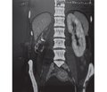 Гідронефротична форма мультикістозної дисплазії нирки, що ускладнилась септичним пієлонефритом: клінічний випадок у дорослої людини