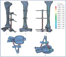 Анализ напряженно-деформированного состояния дистального отдела голени и стопы при повреждениях pilon в условиях наружной фиксации при помощи стержневых аппаратов